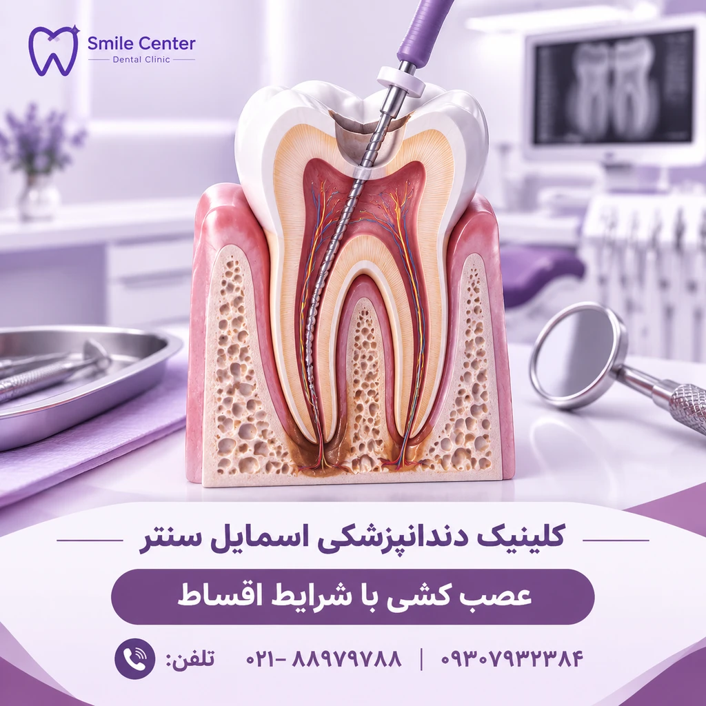 عصب کشی دندان و قیمت آن در کلینیک دندانپزشکی اسمایل سنتر